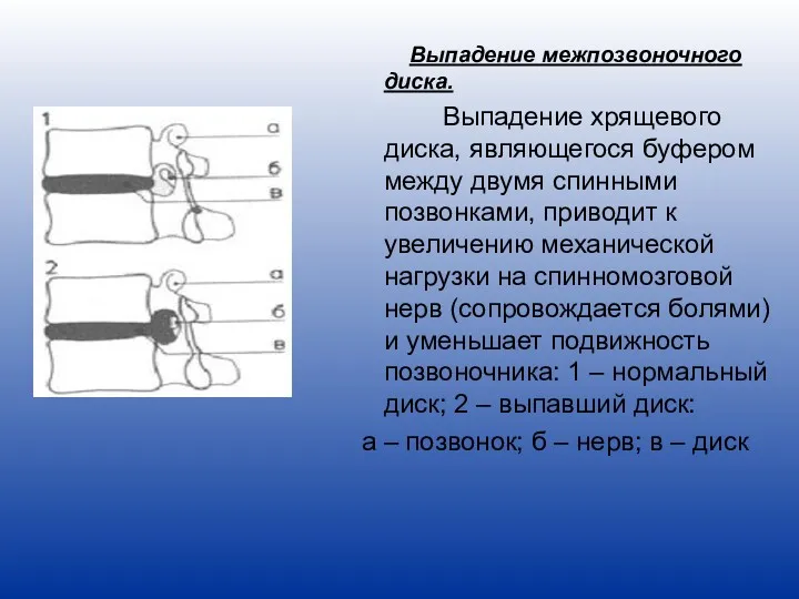 Выпадение межпозвоночного диска. Выпадение хрящевого диска, являющегося буфером между двумя