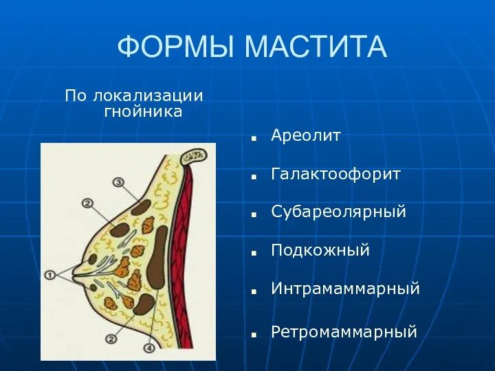 ФОРМЫ МАСТИТА По локализации гнойника Ареолит Галактоофорит Субареолярный Подкожный Интрамаммарный Ретромаммарный