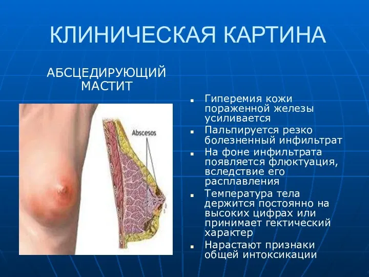 КЛИНИЧЕСКАЯ КАРТИНА АБСЦЕДИРУЮЩИЙ МАСТИТ Гиперемия кожи пораженной железы усиливается Пальпируется