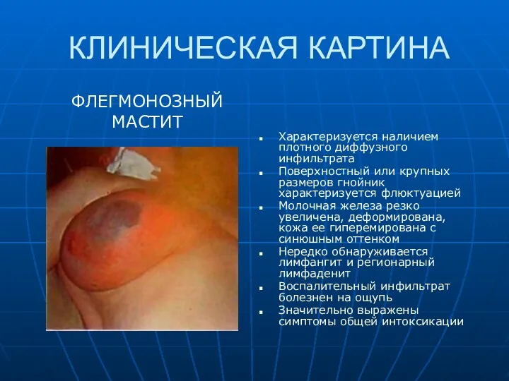 КЛИНИЧЕСКАЯ КАРТИНА ФЛЕГМОНОЗНЫЙ МАСТИТ Характеризуется наличием плотного диффузного инфильтрата Поверхностный