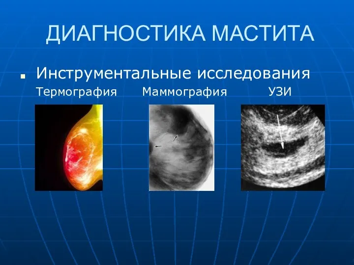 ДИАГНОСТИКА МАСТИТА Инструментальные исследования Термография Маммография УЗИ