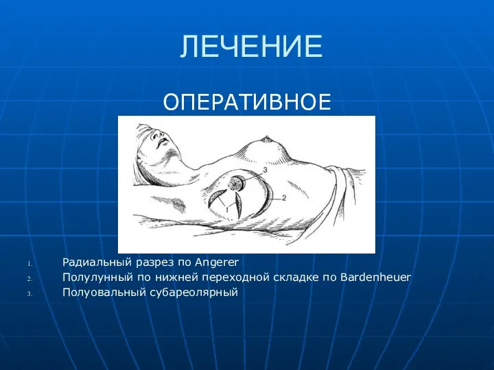 ЛЕЧЕНИЕ ОПЕРАТИВНОЕ Радиальный разрез по Angerer Полулунный по нижней переходной складке по Bardenheuer Полуовальный субареолярный