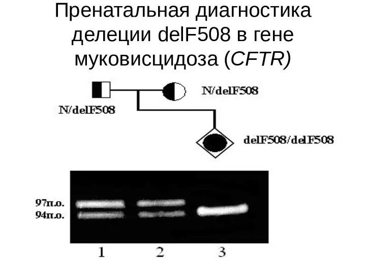 Пренатальная диагностика делеции delF508 в гене муковисцидоза (CFTR)