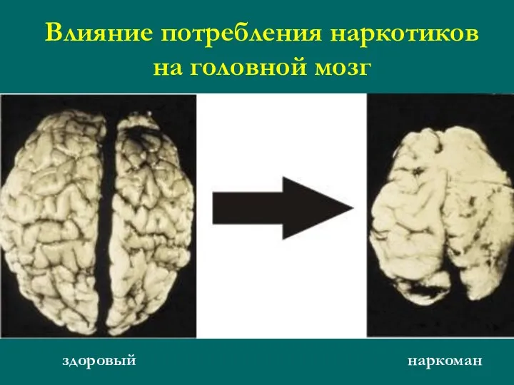 Влияние потребления наркотиков на головной мозг здоровый наркоман