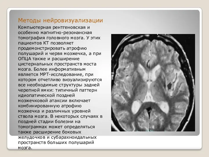 Методы нейровизуализации Компьютерная рентгеновская и особенно магнитно-резонансная томография головного мозга.