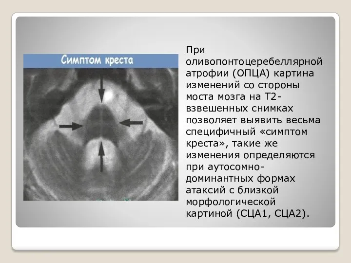 При оливопонтоцеребеллярной атрофии (ОПЦА) картина изменений со стороны моста мозга
