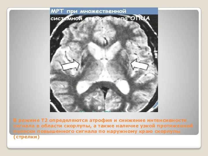 В режиме Т2 определяются атрофия и снижение интенсивности сигнала в