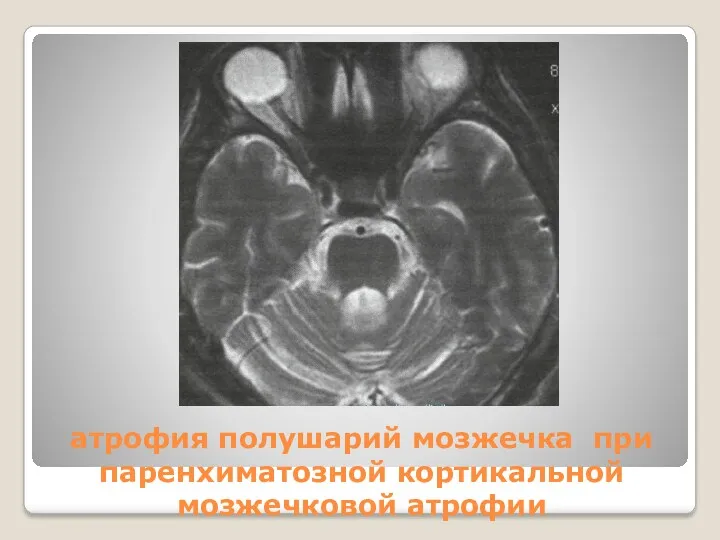 атрофия полушарий мозжечка при паренхиматозной кортикальной мозжечковой атрофии