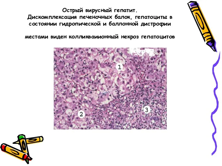 Острый вирусный гепатит. Дискомплексация печеночных балок, гепатоциты в состоянии гидропической и баллонной дистрофии