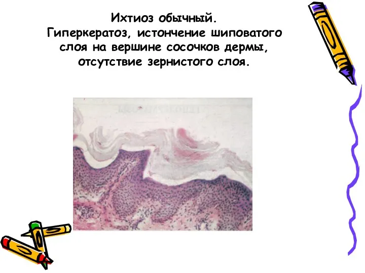 Ихтиоз обычный. Гиперкератоз, истончение шиповатого слоя на вершине сосочков дермы, отсутствие зернистого слоя.