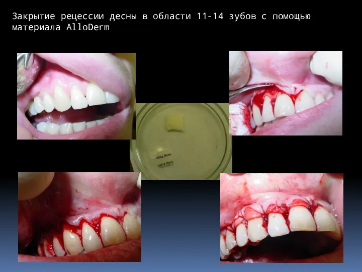 Закрытие рецессии десны в области 11-14 зубов с помощью материала AlloDerm