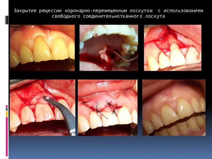 Закрытие рецессии коронарно-перемещенным лоскутом с использованием свободного соединительнотканного лоскута