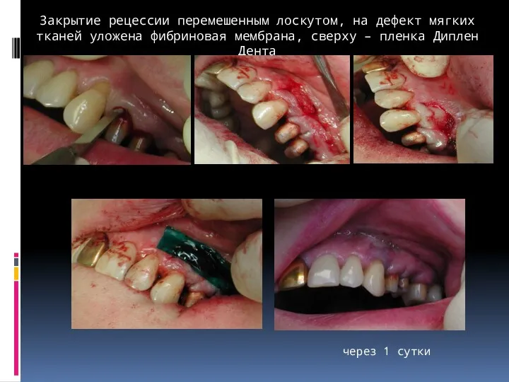 Закрытие рецессии перемешенным лоскутом, на дефект мягких тканей уложена фибриновая