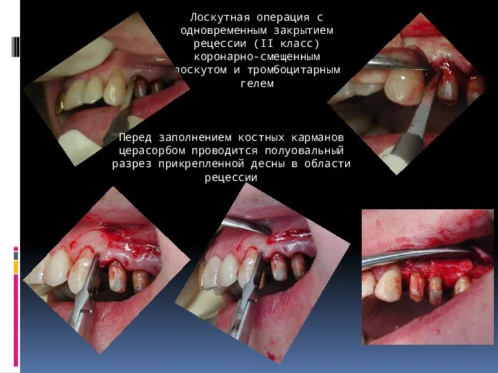 Лоскутная операция с одновременным закрытием рецессии (II класс) коронарно-смещенным лоскутом