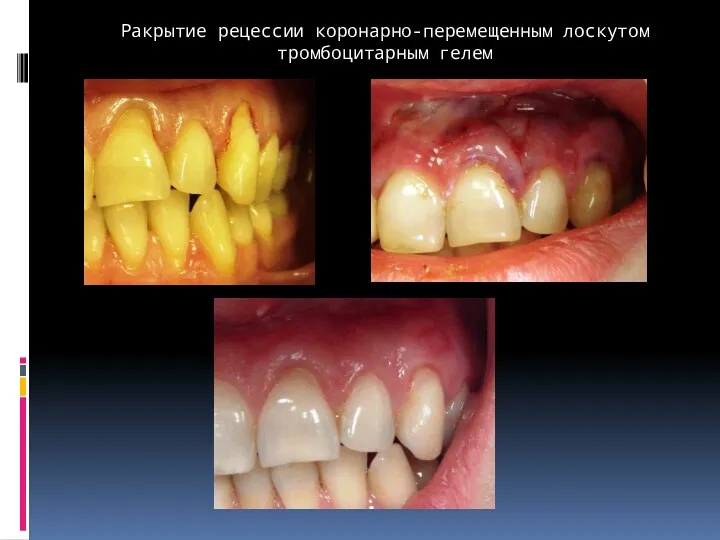 Pакрытие рецессии коронарно-перемещенным лоскутом тромбоцитарным гелем