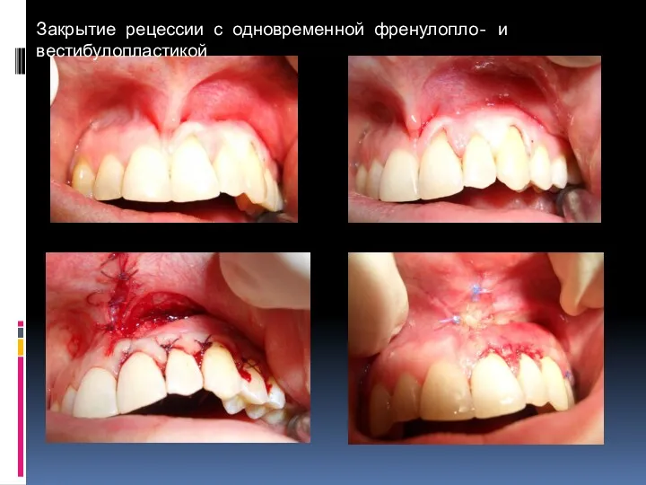 Закрытие рецессии с одновременной френулопло- и вестибулопластикой