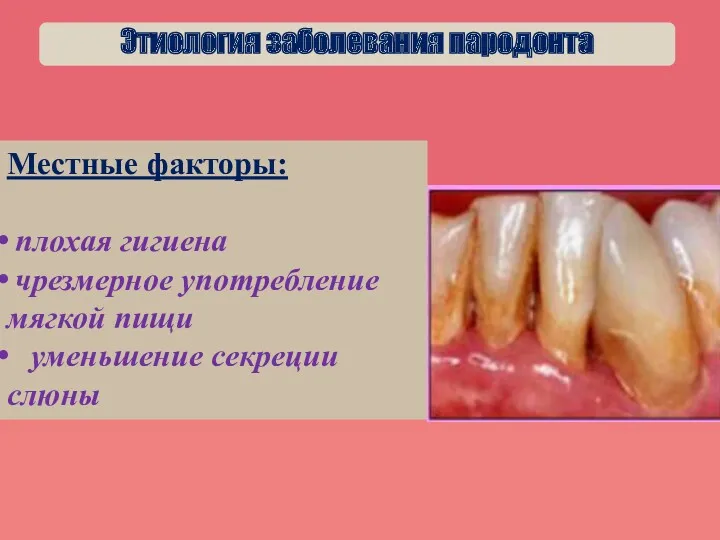 Этиология заболевания пародонта Местные факторы: плохая гигиена чрезмерное употребление мягкой пищи уменьшение секреции слюны