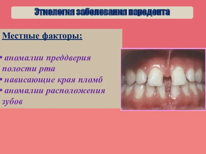 ё Местные факторы: аномалии преддверия полости рта нависающие края пломб аномалии расположения зубов Этиология заболевания пародонта