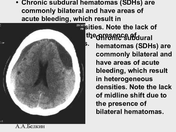 А.А.Белкин Chronic subdural hematomas (SDHs) are commonly bilateral and have areas of acute