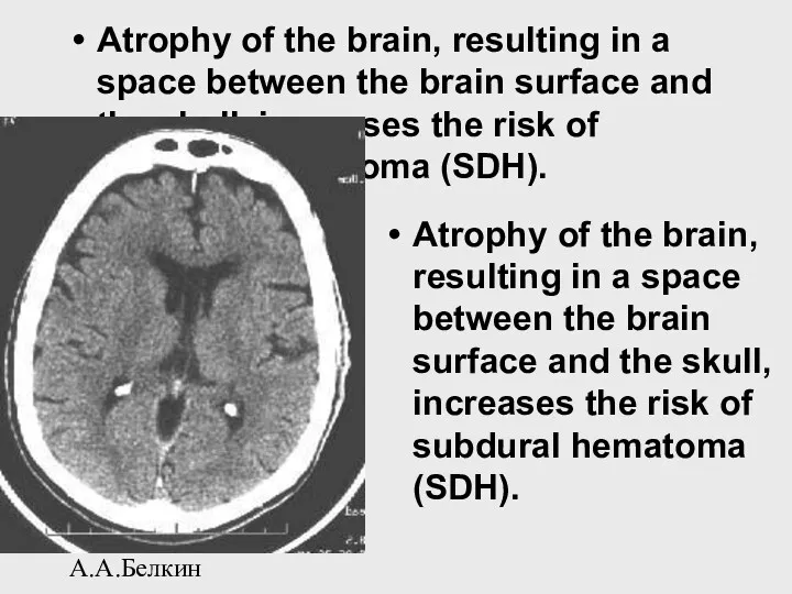 А.А.Белкин Atrophy of the brain, resulting in a space between the brain surface