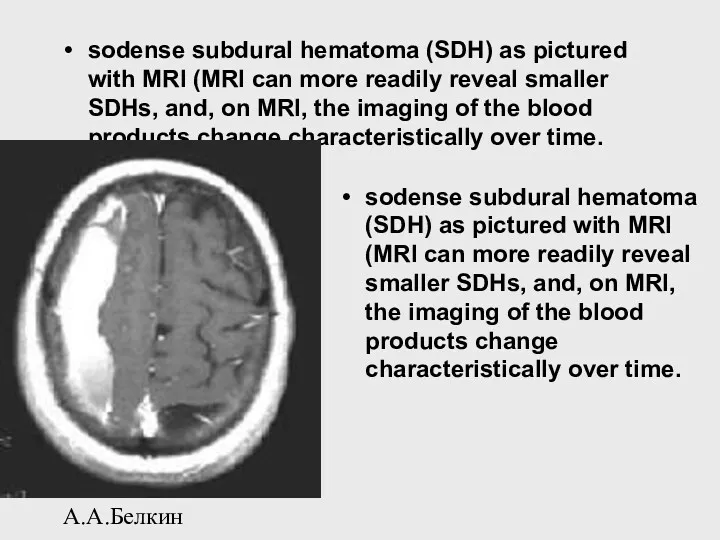 А.А.Белкин sodense subdural hematoma (SDH) as pictured with MRI (MRI can more readily