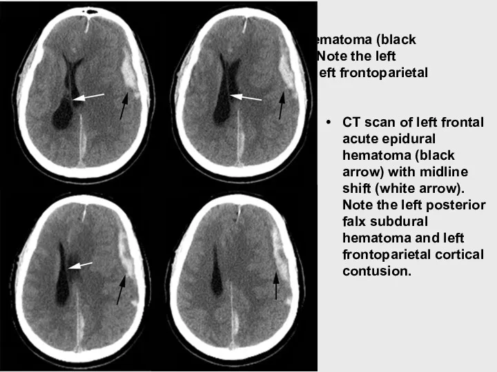 А.А.Белкин CT scan of left frontal acute epidural hematoma (black arrow) with midline