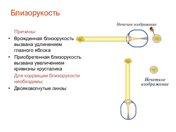 Близорукость Причины: Врожденная близорукость вызвана удлинением глазного яблока Приобретенная близорукость