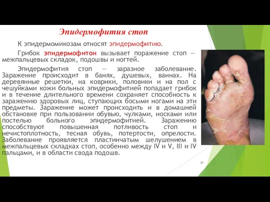 Эпидермофития стоп К эпидермомикозам относят эпидермофитию. Грибок эпидермофитон вызывает поражение