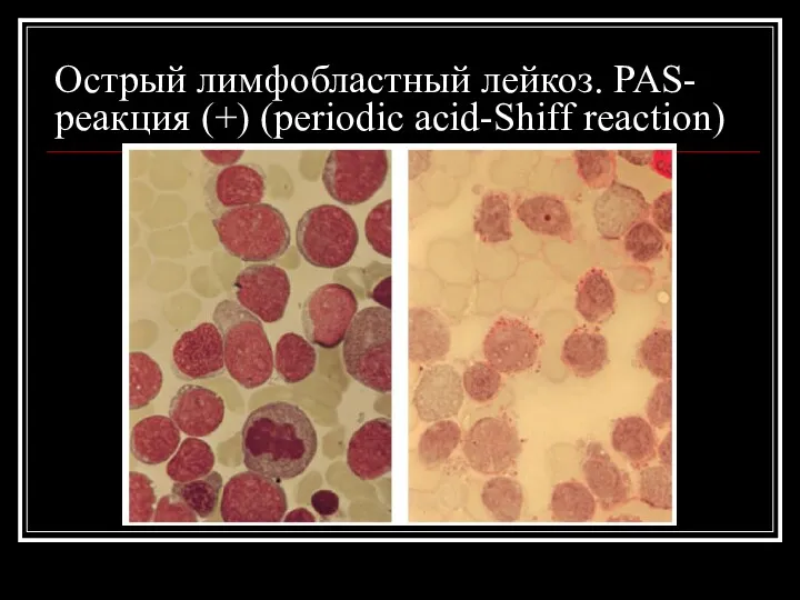 Острый лимфобластный лейкоз. PAS- реакция (+) (periodic acid-Shiff reaction)