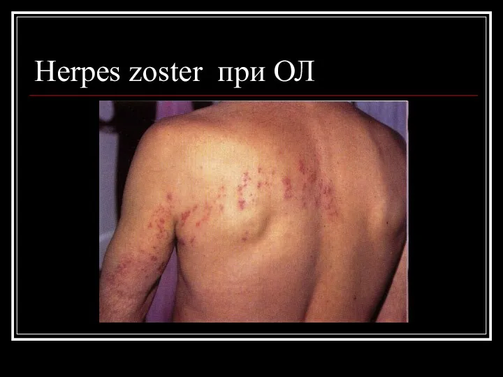 Herpes zoster при ОЛ