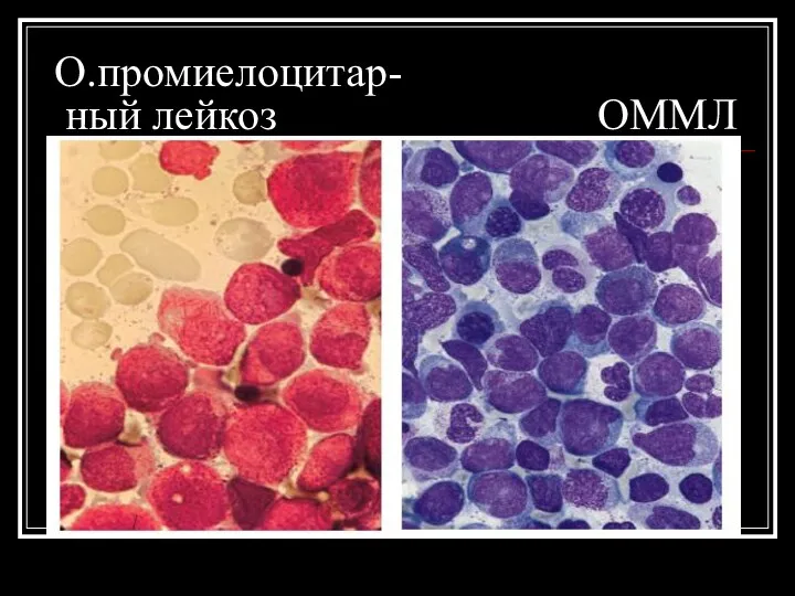 О.промиелоцитар- ный лейкоз ОММЛ