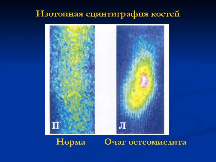 Изотопная сцинтиграфия костей Норма Очаг остеомиелита