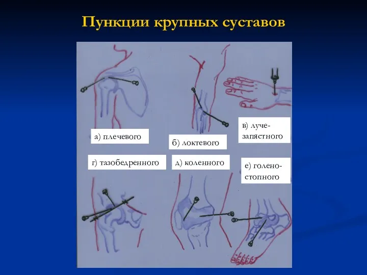 Пункции крупных суставов а) плечевого б) локтевого в) луче-запястного г) тазобедренного д) коленного е) голено-стопного