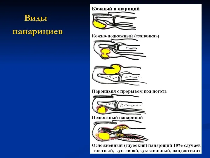 Виды панарициев