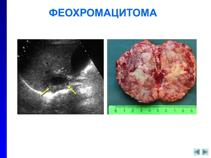 ФЕОХРОМАЦИТОМА