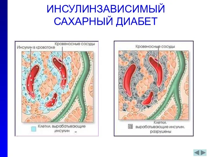 ИНСУЛИНЗАВИСИМЫЙ САХАРНЫЙ ДИАБЕТ