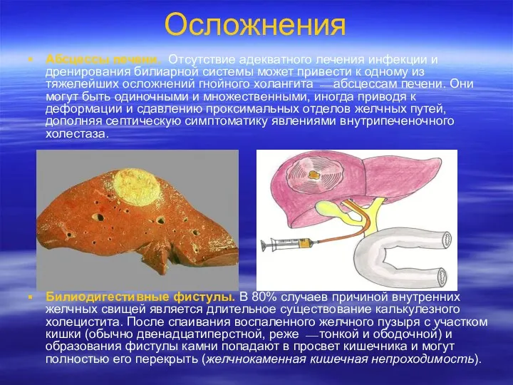 Осложнения Абсцессы печени. Отсутствие адекватного лечения инфекции и дренирования билиарной системы может привести