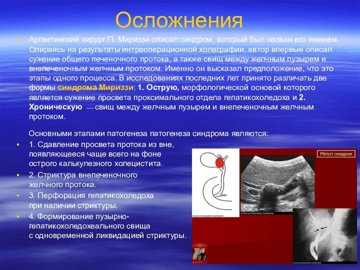 Осложнения Аргентинский хирург П. Мириззи описал синдром, который был назван его именем. Опираясь