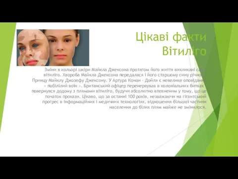 Цікаві факти Вітиліго Зміни в кольорі шкіри Майкла Джексона протягом