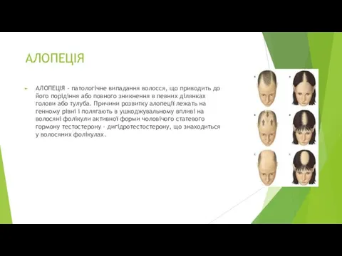 АЛОПЕЦІЯ АЛОПЕЦІЯ - патологічне випадання волосся, що приводить до його