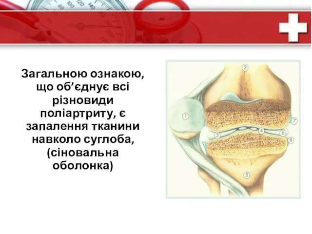 Загальною ознакою, що об’єднує всі різновиди поліартриту, є запалення тканини навколо суглоба, (сіновальна оболонка)