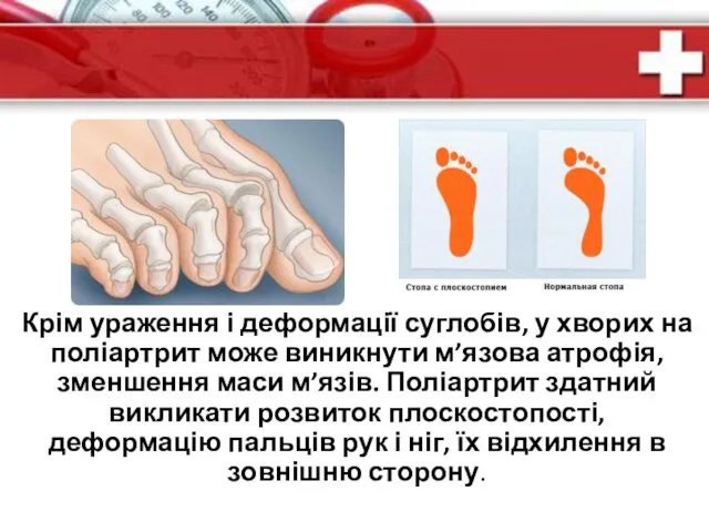 Крім ураження і деформації суглобів, у хворих на поліартрит може