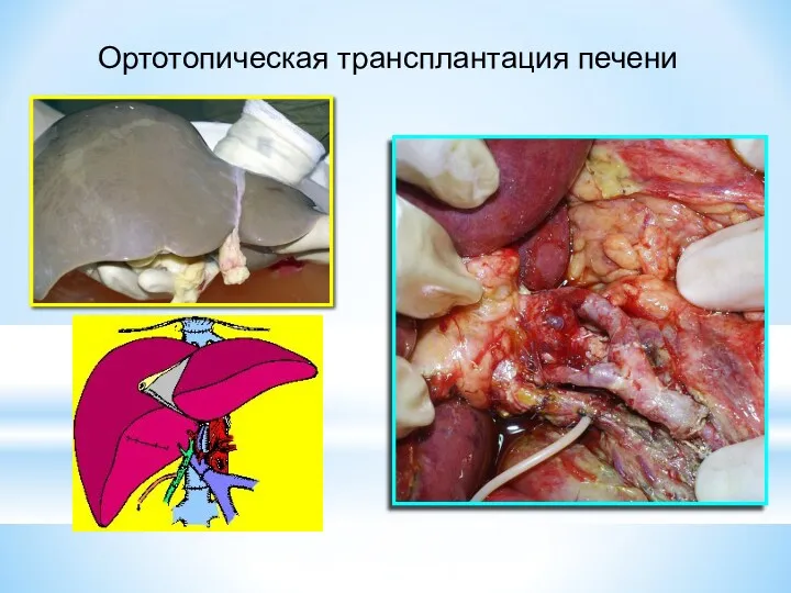 Ортотопическая трансплантация печени