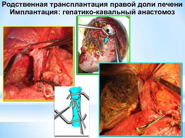 Родственная трансплантация правой доли печени Имплантация: гепатико-кавальный анастомоз