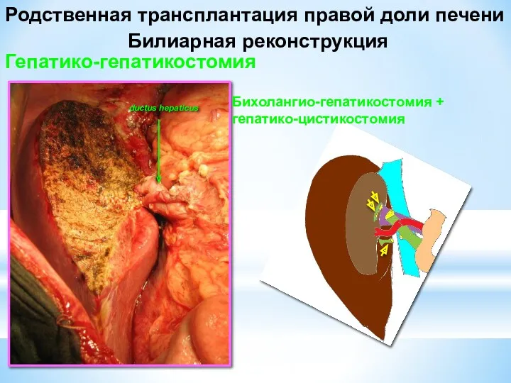 ductus hepaticus Родственная трансплантация правой доли печени Билиарная реконструкция Гепатико-гепатикостомия Бихолангио-гепатикостомия + гепатико-цистикостомия