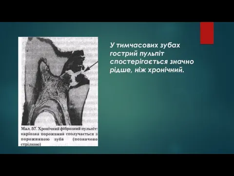 У тимчасових зубах гострий пульпіт спостерігається значно рідше, ніж хронічний.