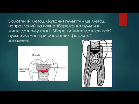 Біологічний метод лікування пульпіту – це метод, направлений на повне