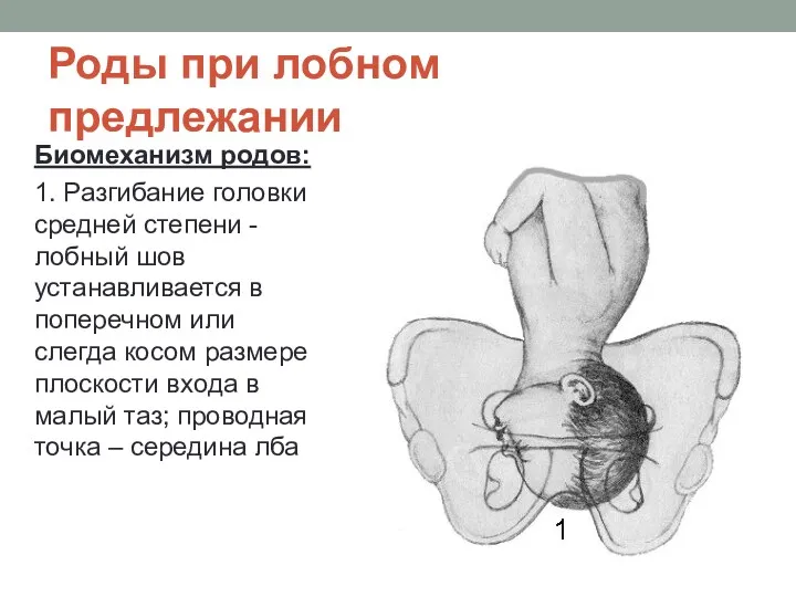 Роды при лобном предлежании Биомеханизм родов: 1. Разгибание головки средней