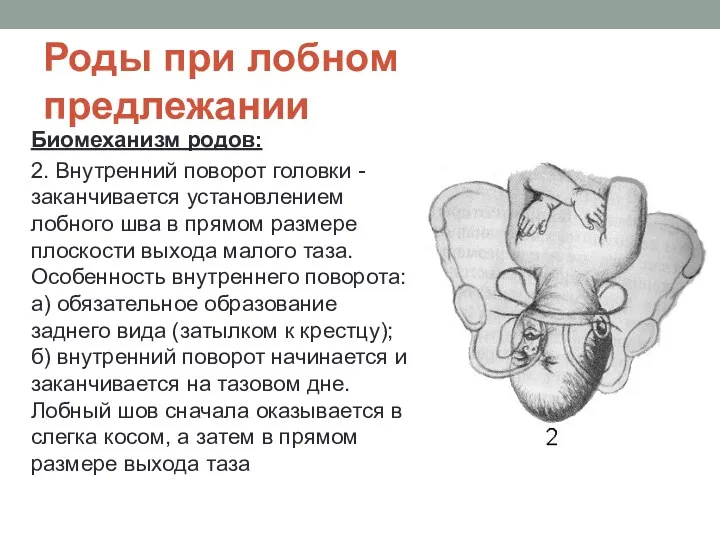 Роды при лобном предлежании Биомеханизм родов: 2. Внутренний поворот головки