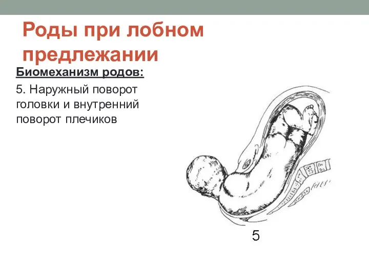 Роды при лобном предлежании Биомеханизм родов: 5. Наружный поворот головки и внутренний поворот плечиков